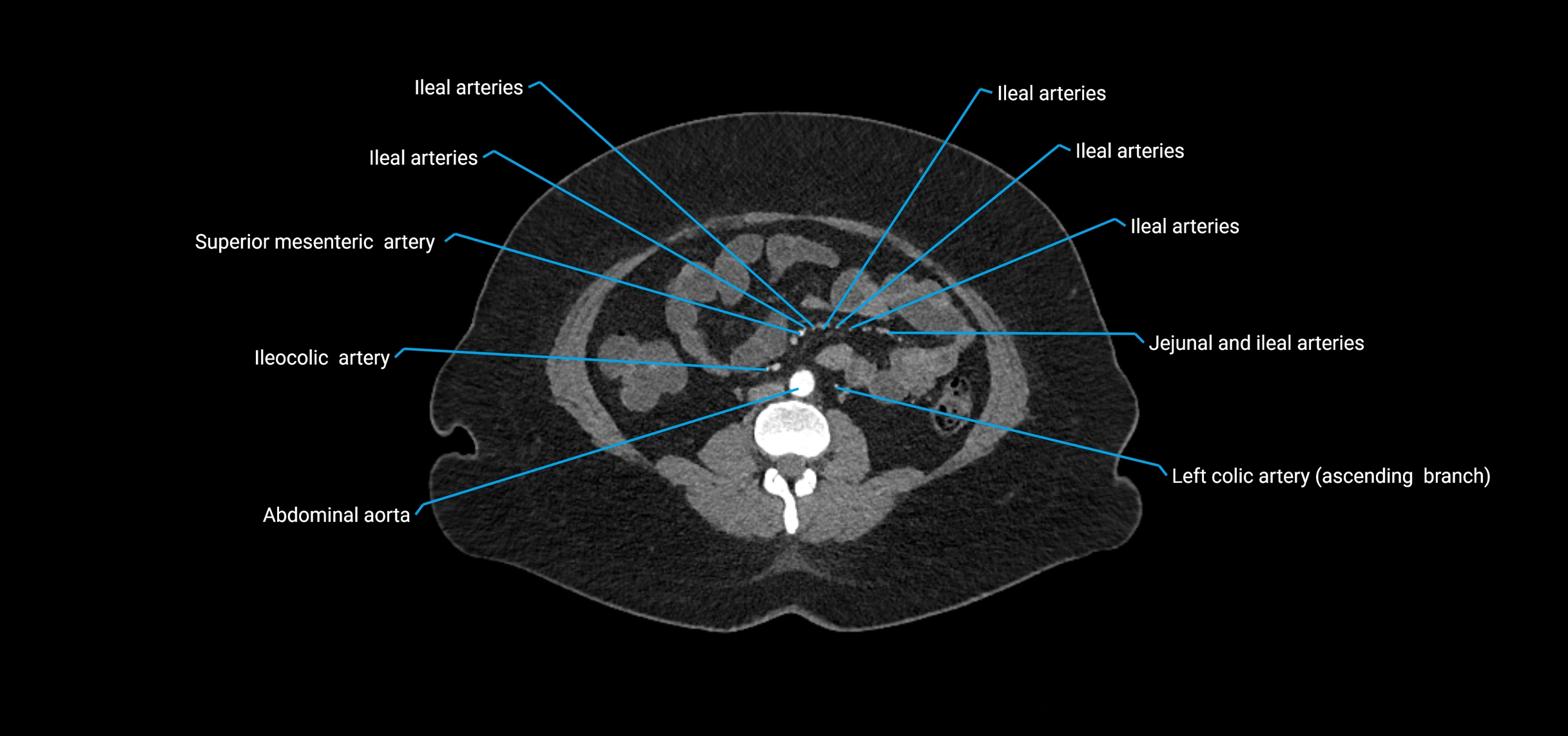CTA abdomen axial cross sectional anatomy labelled image_108 (2).webp